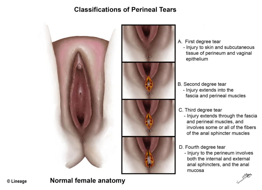 An illustration showing different degrees of vaginal tears, including first, second, third, and fourth degree tears.